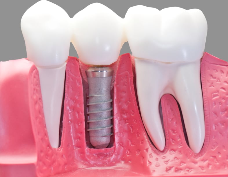 Capped Dental Implant Model
