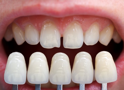 improve your smile with veneers