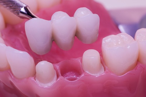 Dental bridges how it works