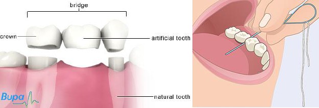 bridgefloss-complete